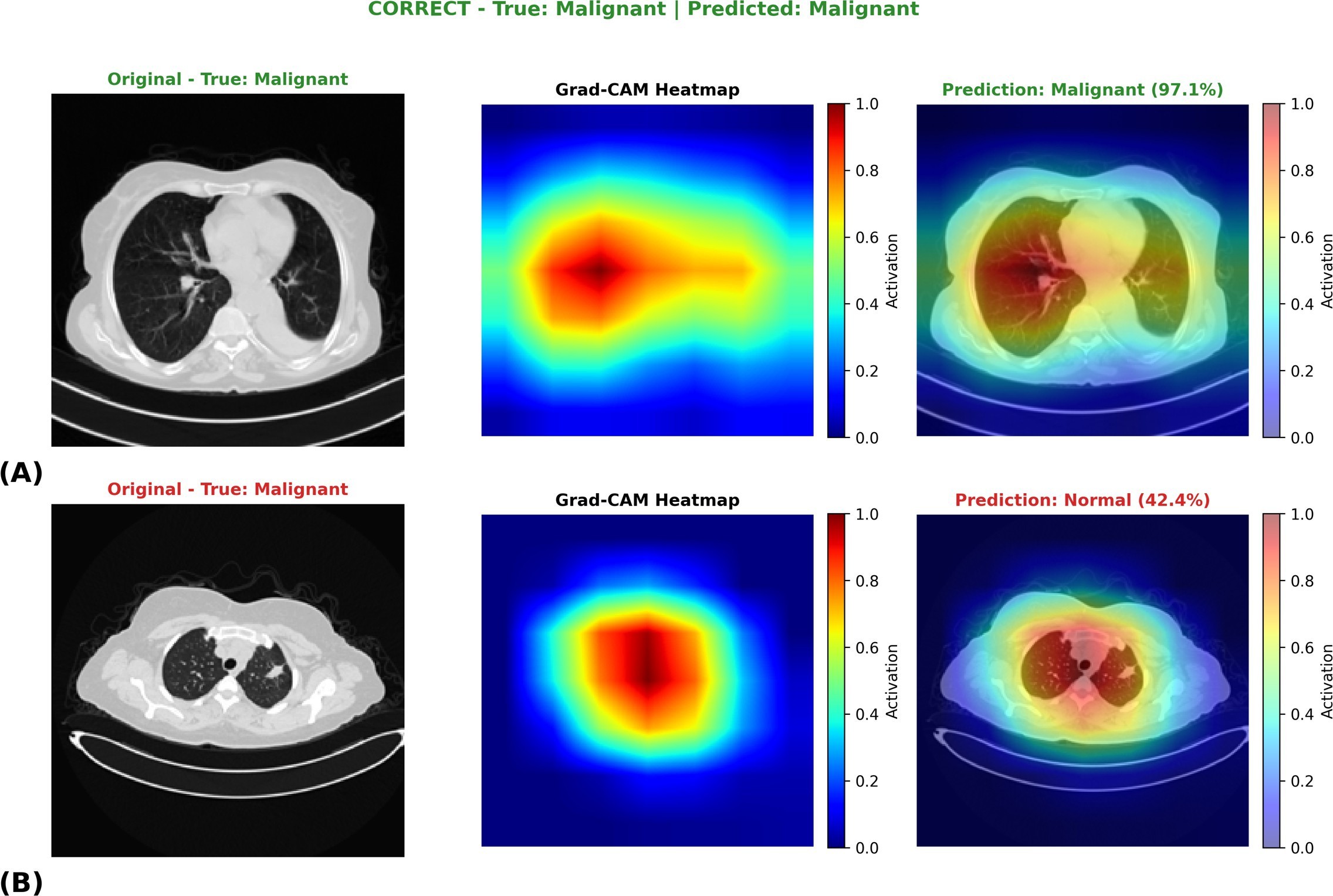 Grad-CAM visualization of model attention for lung CT classification. (A) Correct prediction showing focal activation. (B) Misclassified case showing less confident activation patterns, reflecting diagnostic uncertainty. Warmer colors indicate stronger network activation.